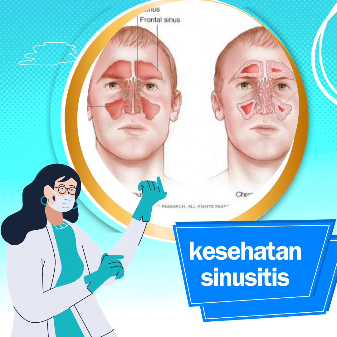 Gejala Sinusitis Berikut Cara Mengatasinya Sijasapedia